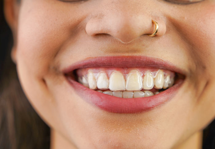 smiling woman showing teeth with clear aligners and a nose ring, highlighting dental aesthetics